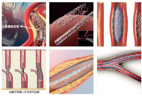 血管支架激光切割加工工艺应用.png